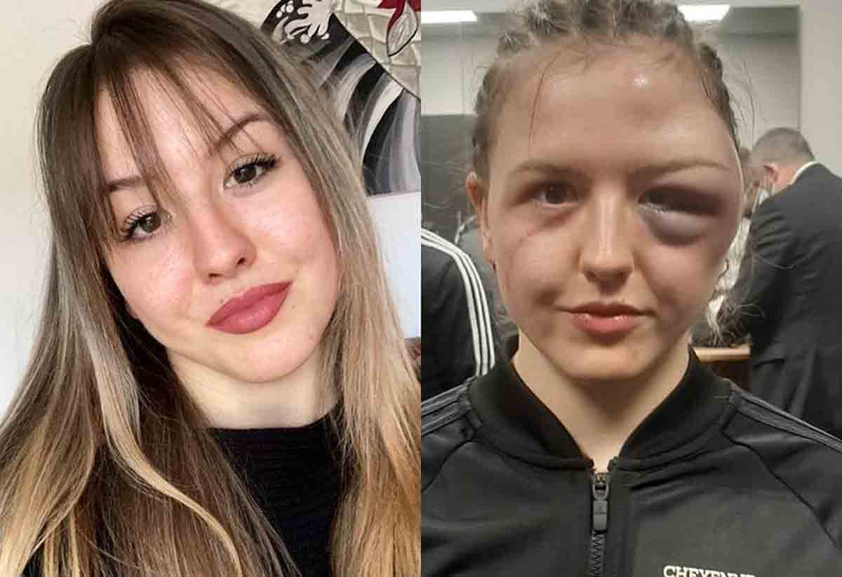 Boxeadora fica com o rosto deformado após disputa por cinturão boxe. Foto: reprodução instagram
