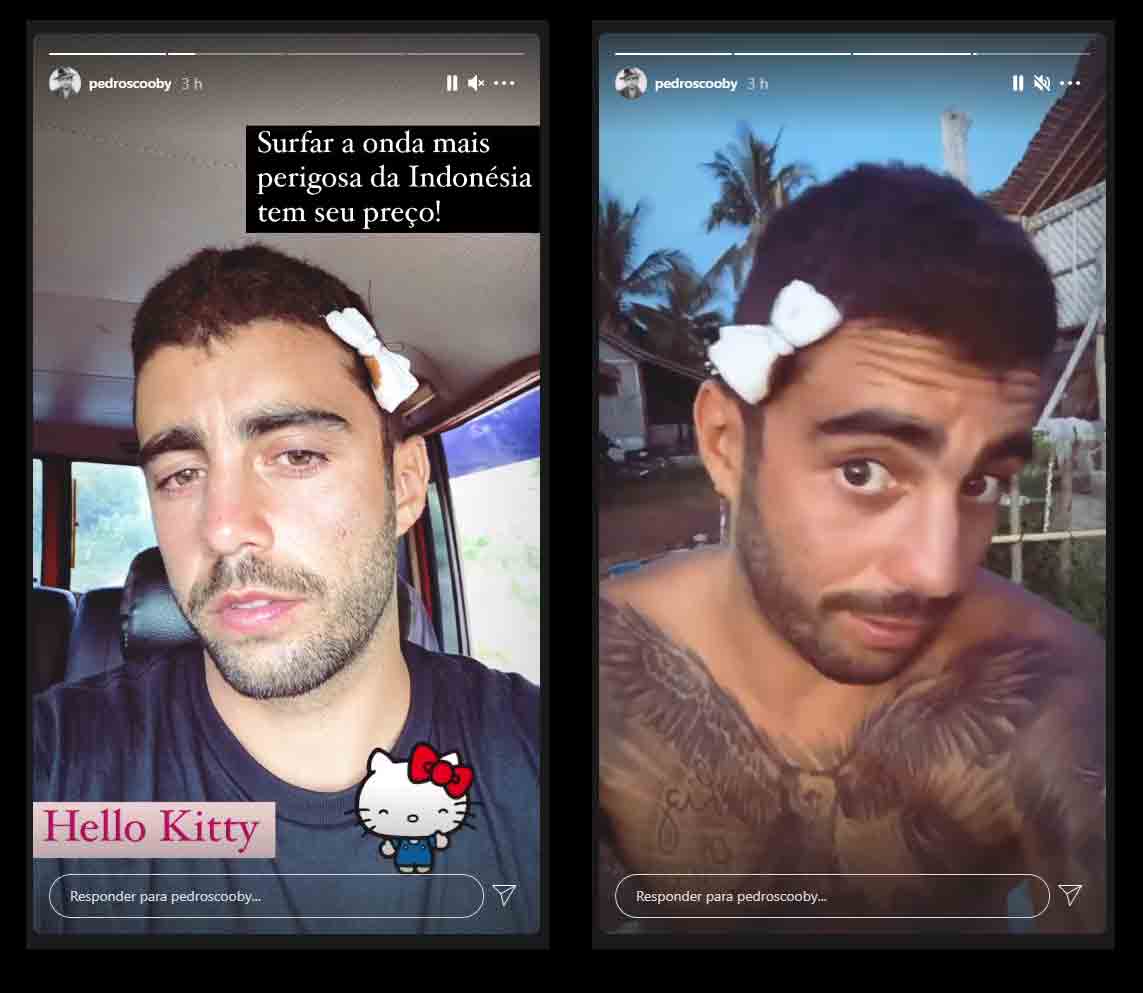 Pedro Scooby mostra pontos na cabeça após se machucar na Indonésia. Foto: Reprodução Instagram