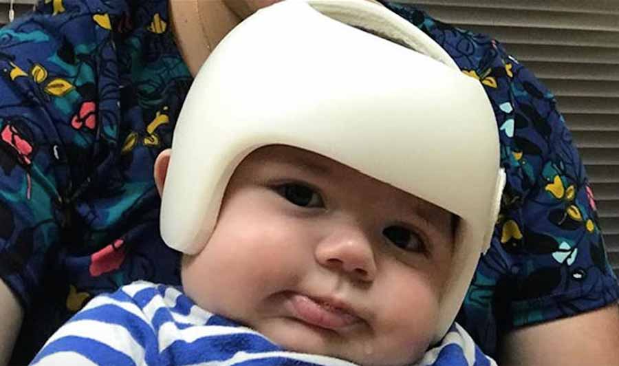 Família passa a usar capacetes para apoiar bebê de 4 meses