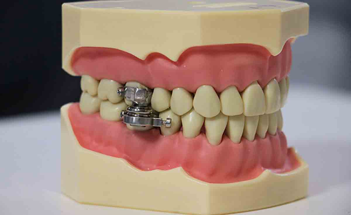 Cientistas desenvolvem "dispositivo para perder peso" que trava as mandíbulas das pessoas. Foto: Reprodução Twitter