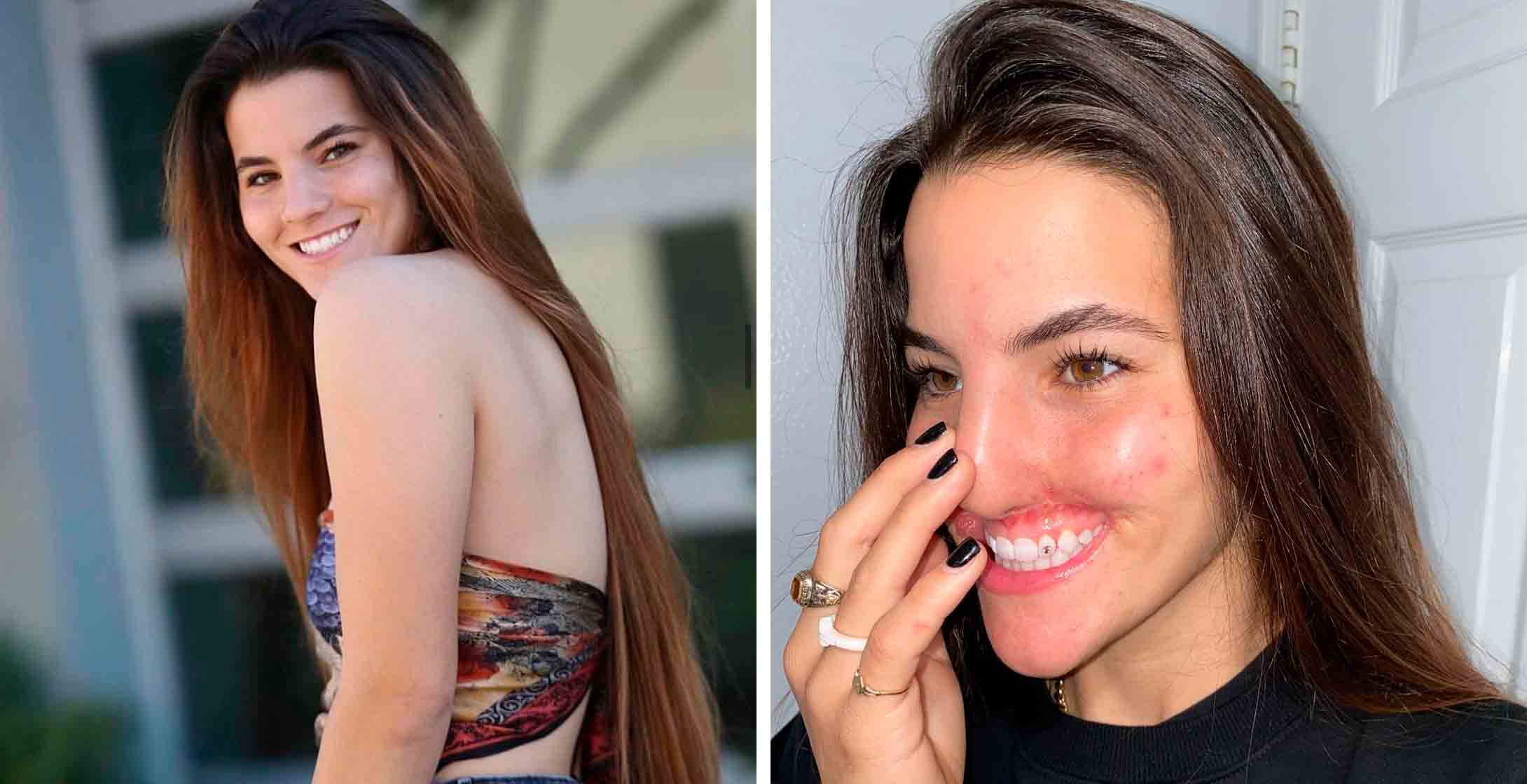 Vídeo: Veja o antes e depois da modelo Brooklinn Khoury, que teve o rosto desfigurado por ataque de cachorro. Foto: Reprodução Instagram