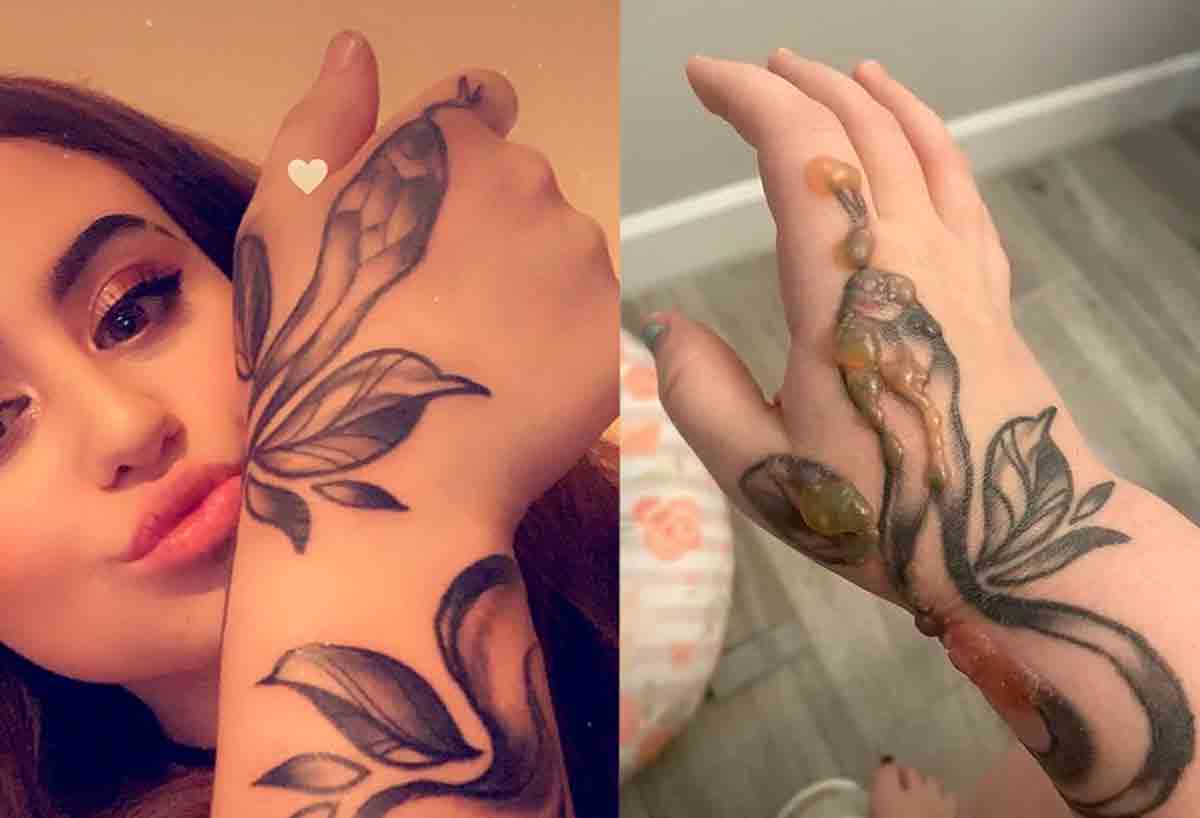 Mulher fica horrorizada quando verrugas começam a crescer na tatuagem de sua mão. Foto: Reprodução Instagram