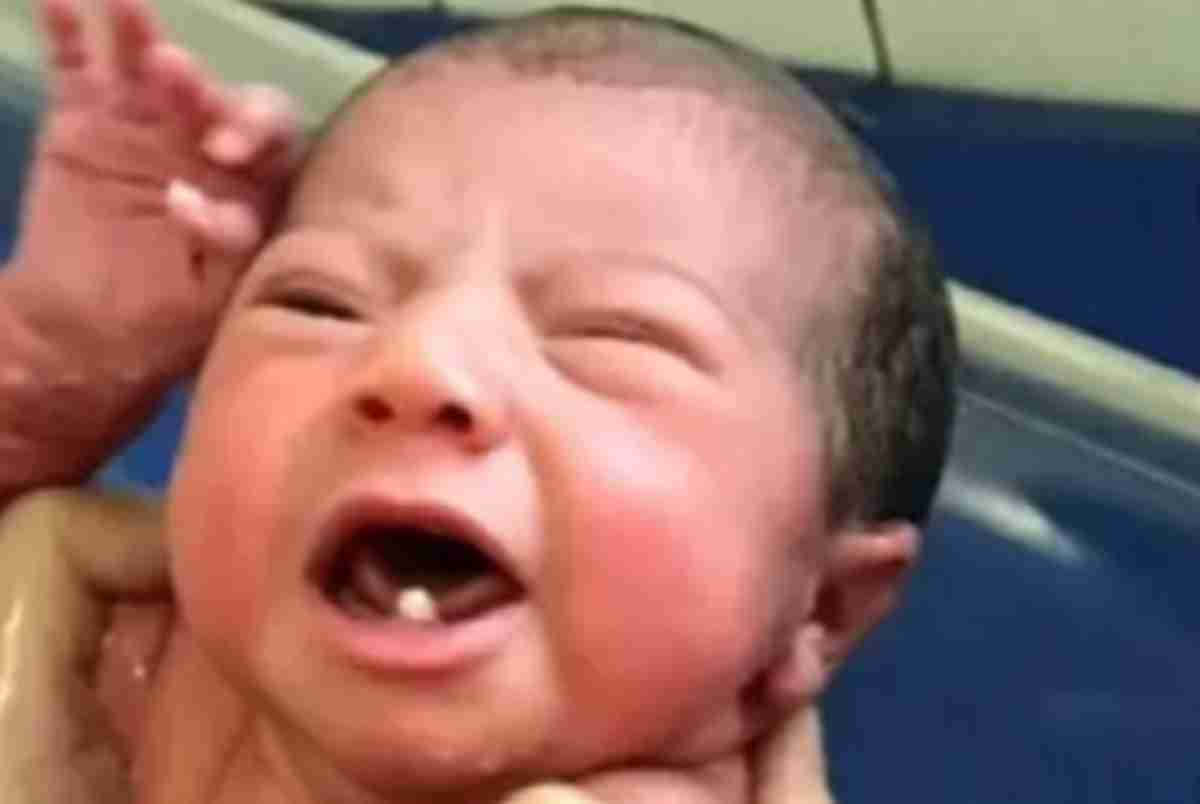 Bebê nasce com dois dentes e viraliza no TikTok