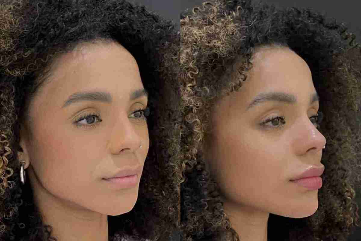 Antes e depois: Brunna Gonçalves faz harmonização facial (Foto: Reprodução/Instagram)