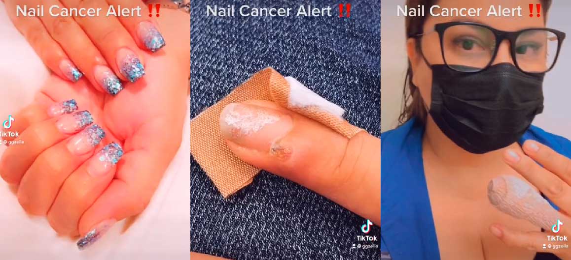 VÍDEO: Mulher desenvolve cancer de pele após ida a manicure