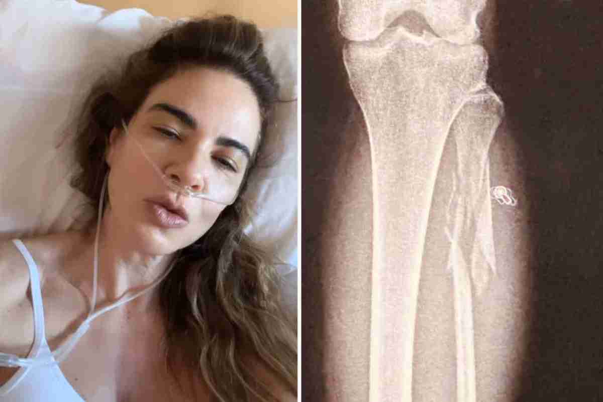 Luciana Gimenez recebe alta do hospital após quebrar a perna em acidente nos EUA (Foto: Reprodução/Instagram)