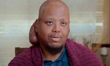 See the before and after of the surgery that removed a melon-sized tumor from a man's neck. Photos: YouTube @TLC