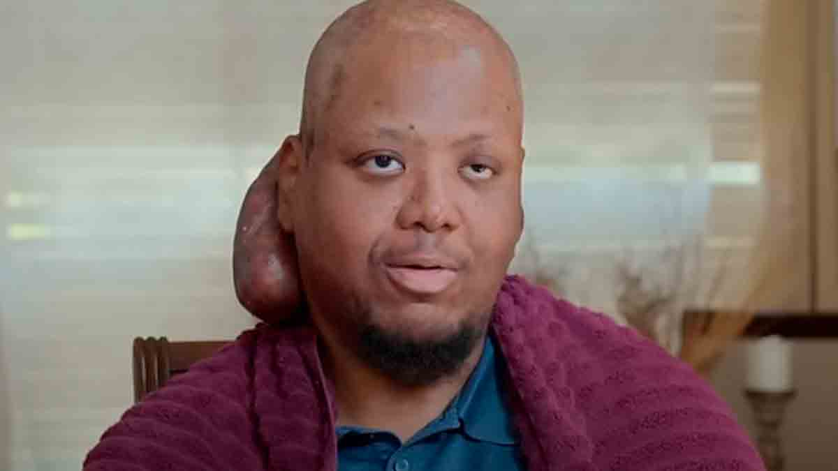 See the before and after of the surgery that removed a melon-sized tumor from a man's neck. Photos: YouTube @TLC